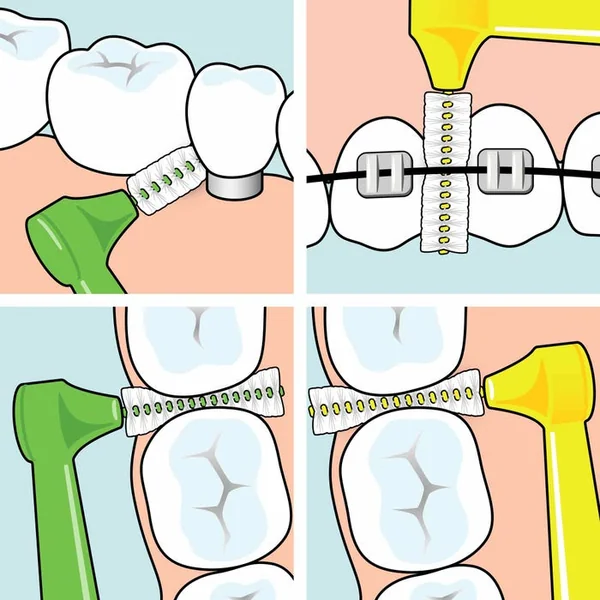 ANGLE - Brossettes Interdentaires taille 5 0.8 mm, 6 Unités