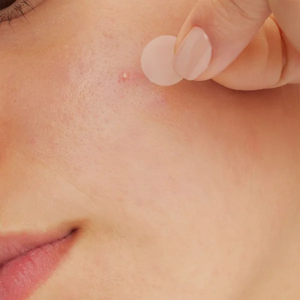 Patchs Anti-Imperfections - Peaux à Imperfections et à Tendance Acnéique, 22 patchs